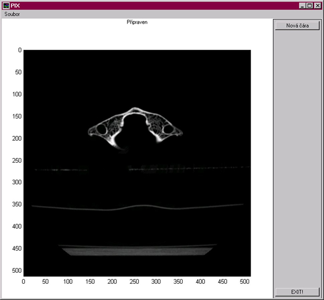 Jeden řez ze sekvence CT snímků lidského krčního obratle