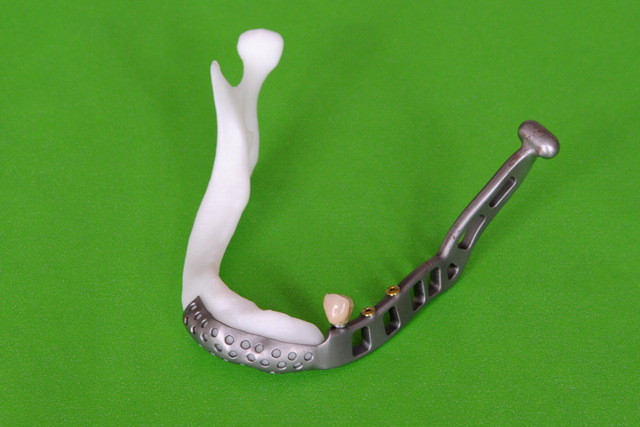 An individual mandibular implant